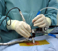 脊柱管狭窄症の手術